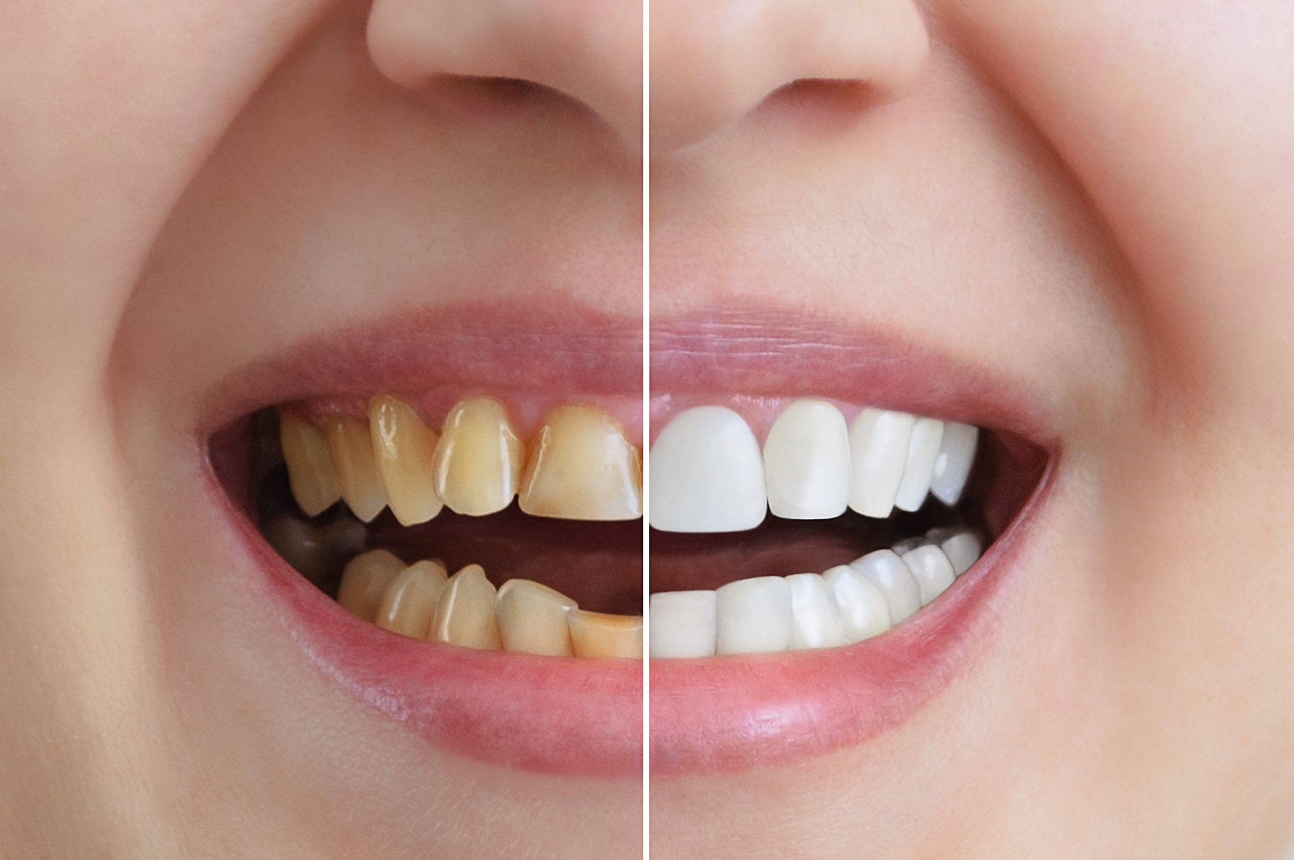 Shine Bright Like a Diamond: Teeth Whitening for the Win