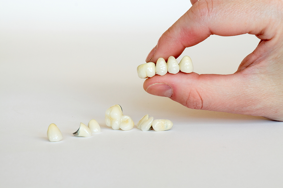 Restoring Your Smile with Crowns and Bridges in Hayward, CA