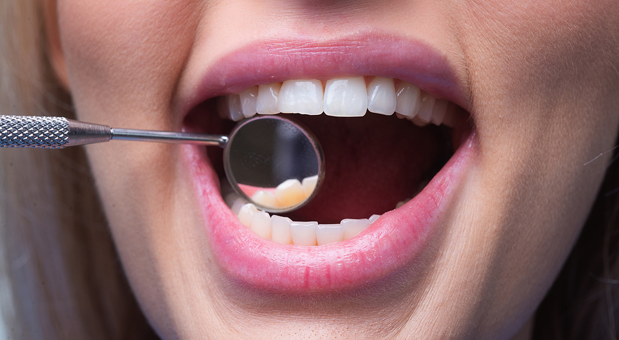 How Dental Crowns Help After a Root Canal